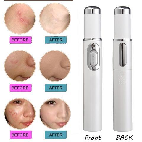 Wrinkles, blemishes, pores, acne scar removal pen